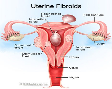 Do Fibroids Cause Blood in Urine